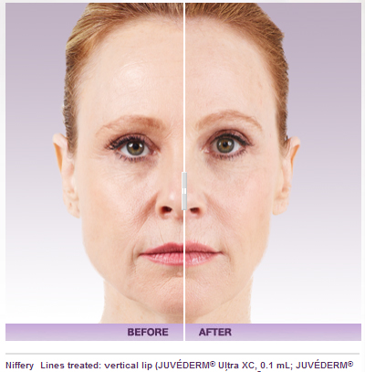 Botox | Anti-Aging | Injectables | Plastic Surgery | Torrence